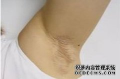 大连莱西狐臭专家介绍狐臭的护理常识有哪些