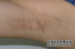 大连狐臭疾病该怎样预防