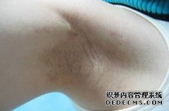 大连青岛小孩子为什么会得狐臭