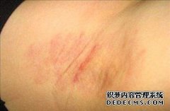大连青岛狐臭专家解析狐臭的病因有哪些