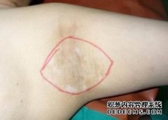 大连女孩腋臭的治疗方法