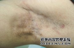 大连青岛患者咨询:狐臭手术到底什么是微创