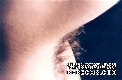 大连青岛夏季来临狐臭患