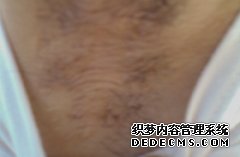 大连崂山女性采用药物根治腋臭有哪些危害呢